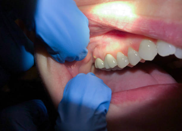 Best Emergency Dentist for Knocked-Out Tooth in Mount Shasta, CA